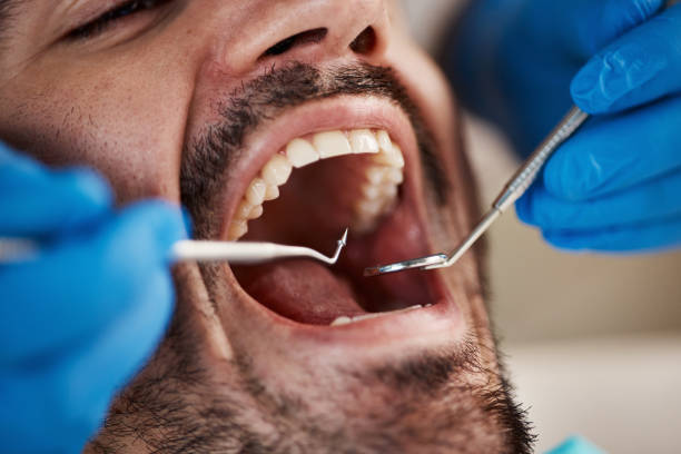Best Emergency Tooth Extraction in Silsbee, TX